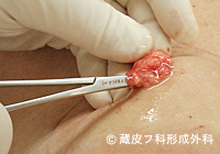 脂肪腫（しぼうしゅ）の手術例・手術方法、手順3