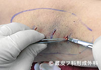 わきが手術方法 2：剪除法＋超音波破壊吸引法